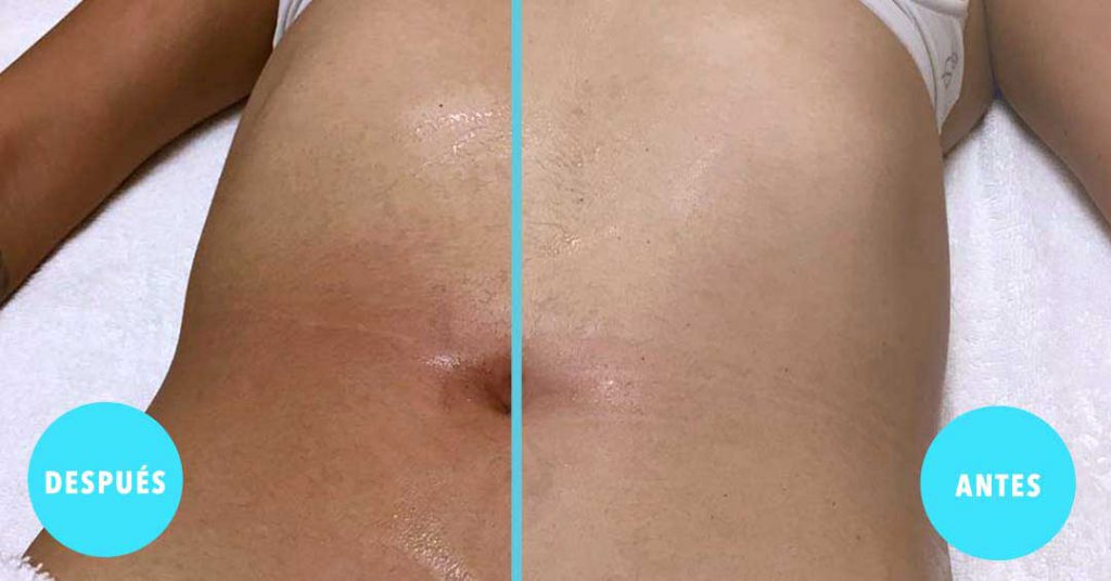 Lipo sin cirugia | Moompaya Spa